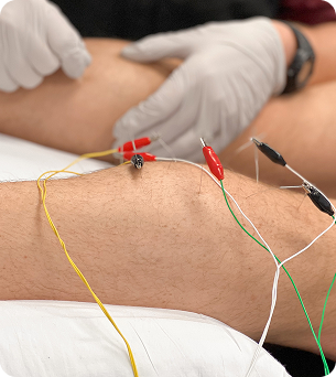 Dry Needling 2